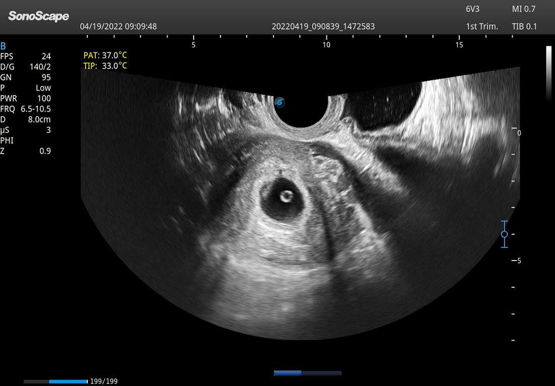 SonoScape P25 Elite Trolley 3D/4D Color Doppler Ultrasound Machine