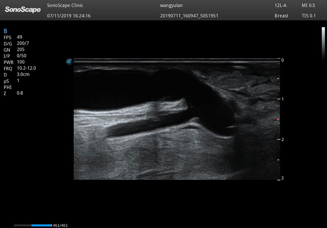Sonoscape P60 mobile ultrasound doppler machines for sales
