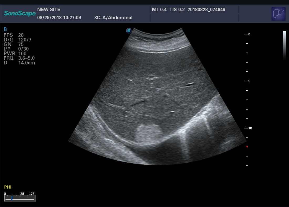 Color Doppler Trolley Ultrasound Scanner Sonoscape P20