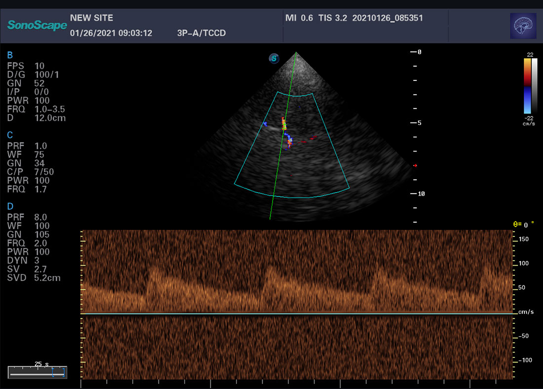 Color Doppler Trolley Ultrasound Scanner Sonoscape P20