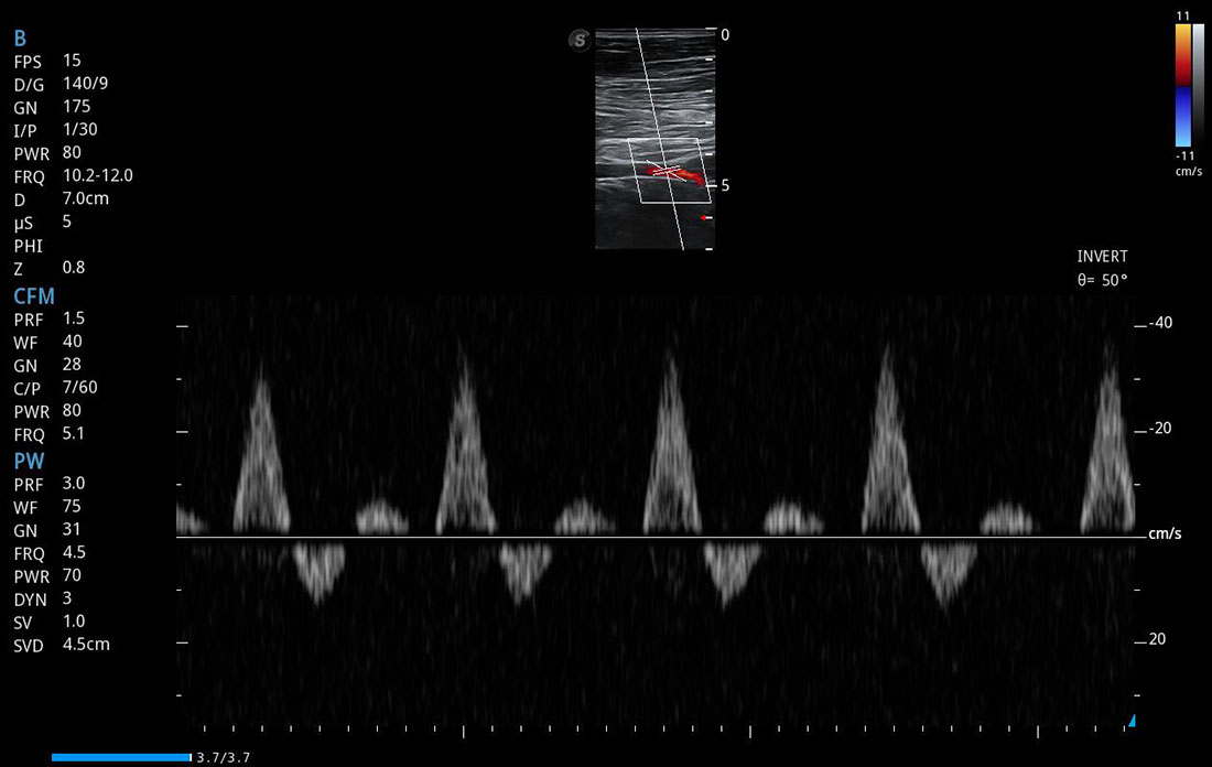 Sonoscape P50 Elite mobile color doppler ultrasound machine