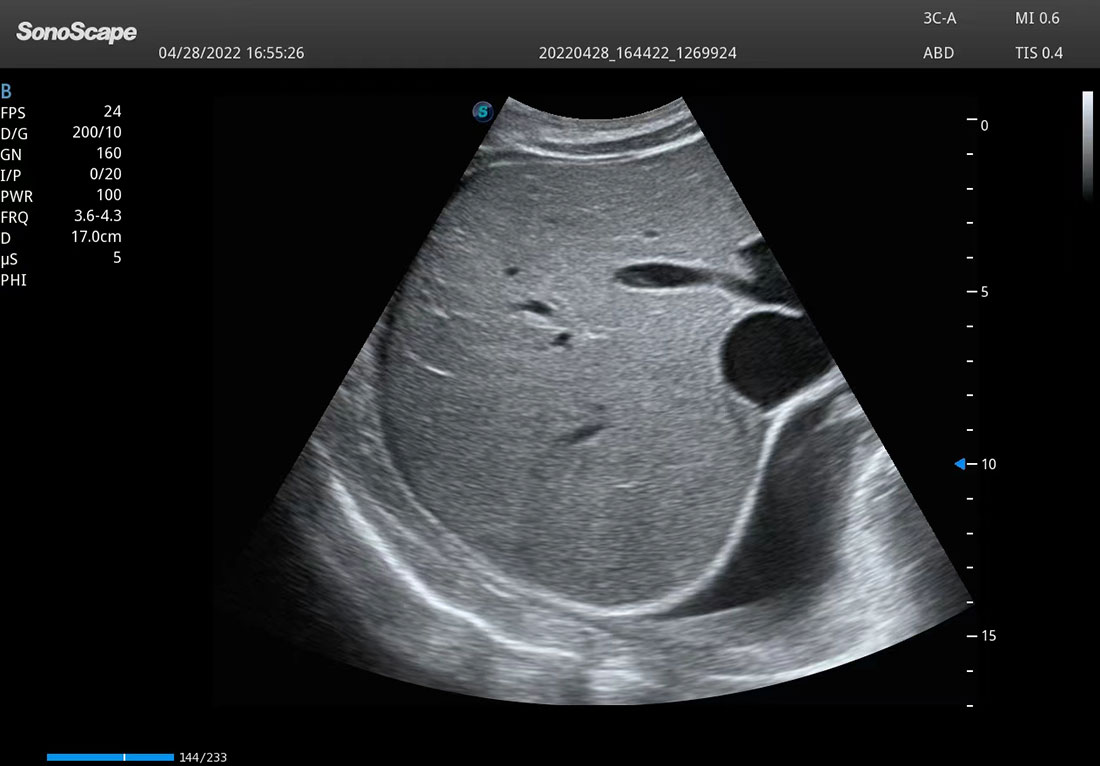 SonoScape P25 Elite Trolley 3D/4D Color Doppler Ultrasound Machine
