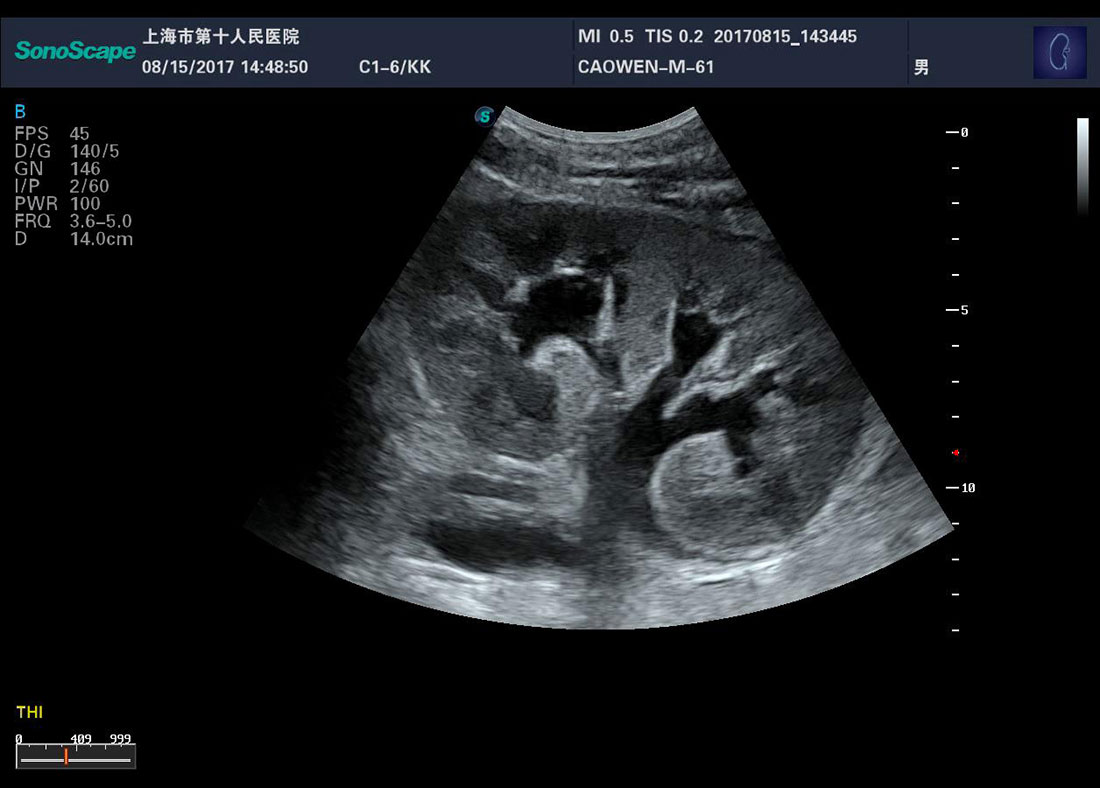 Sonoscape P50 4D Trolley Color Doppler Ultrasound Machine