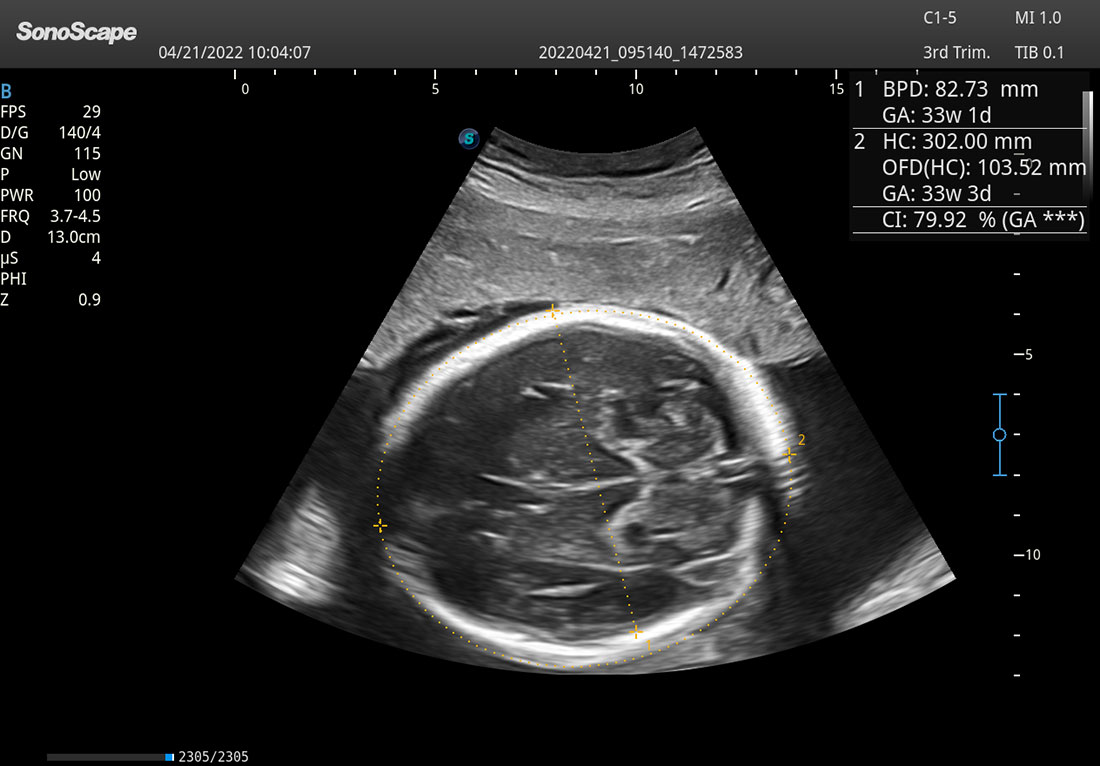 SonoScape P25 Elite Trolley 3D/4D Color Doppler Ultrasound Machine