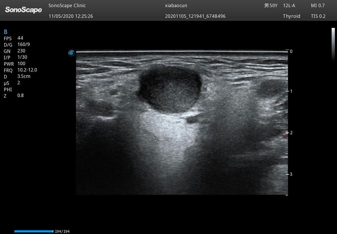 Sonoscape P50 Elite mobile color doppler ultrasound machine