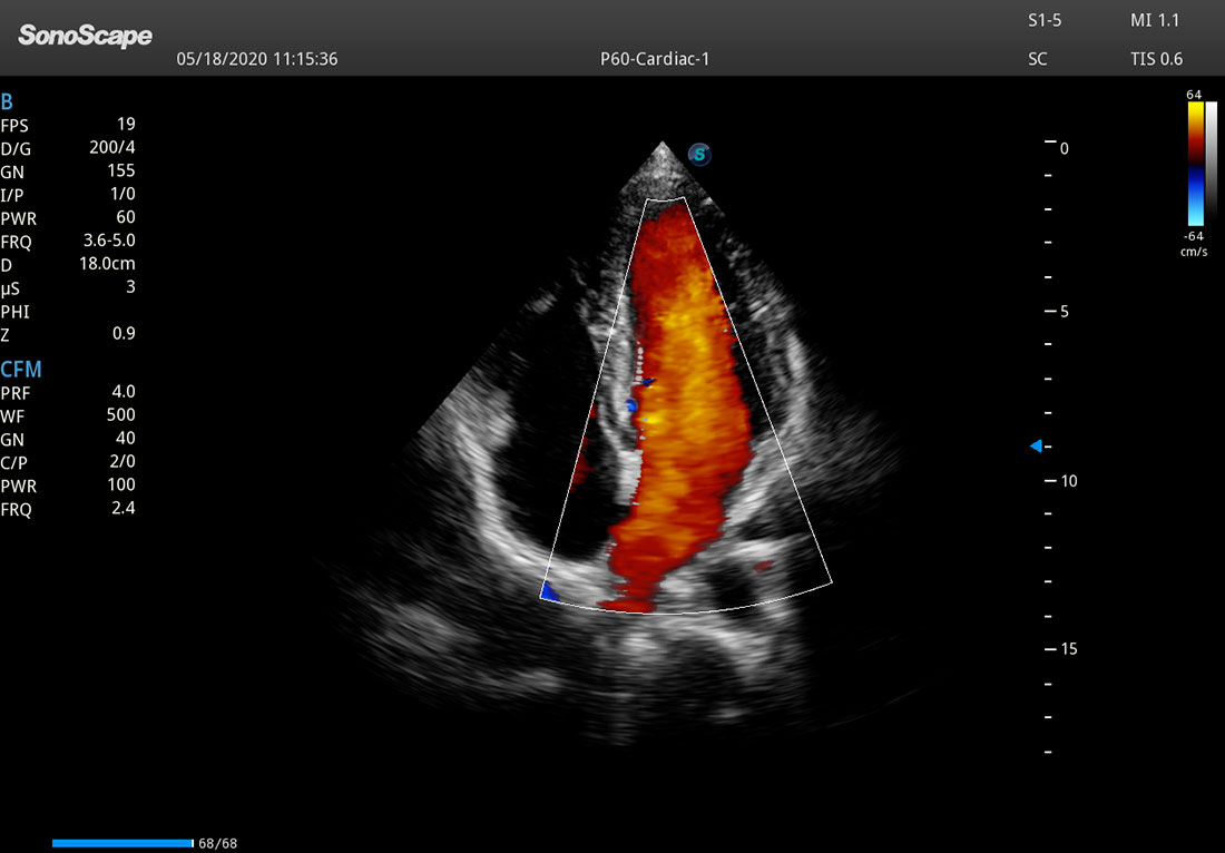 Sonoscape P60 mobile ultrasound doppler machines for sales