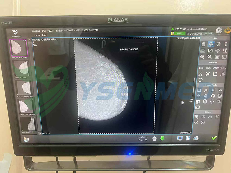 mammography x-ray system