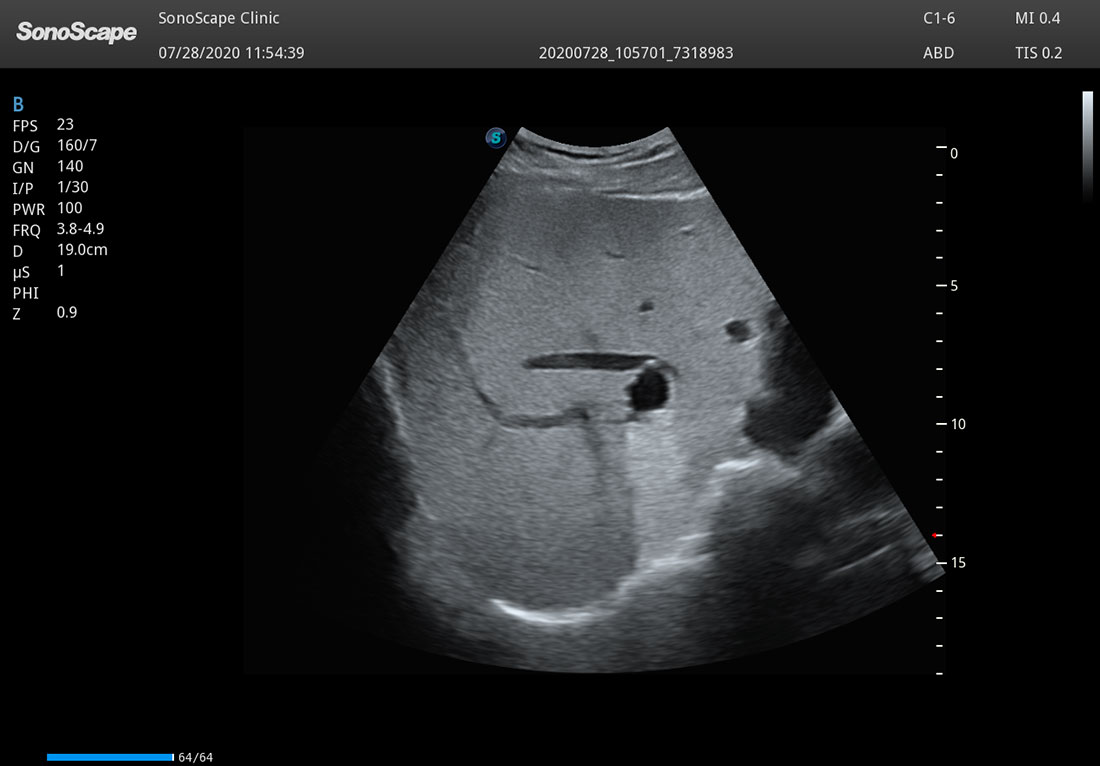 Sonoscape P50 Elite mobile color doppler ultrasound machine