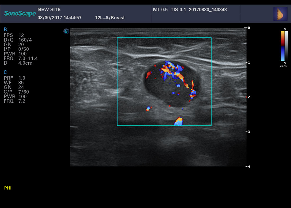 Sonoscape P50 4D Trolley Color Doppler Ultrasound Machine