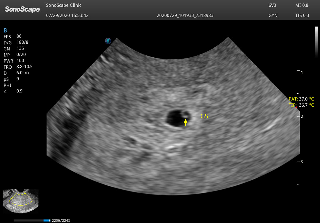 Sonoscape P50 Elite mobile color doppler ultrasound machine