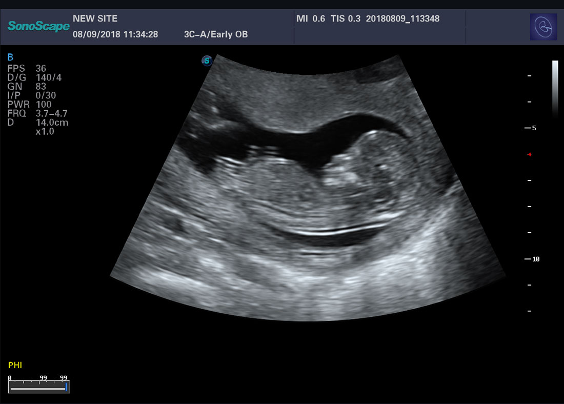 Color Doppler Trolley Ultrasound Scanner Sonoscape P20