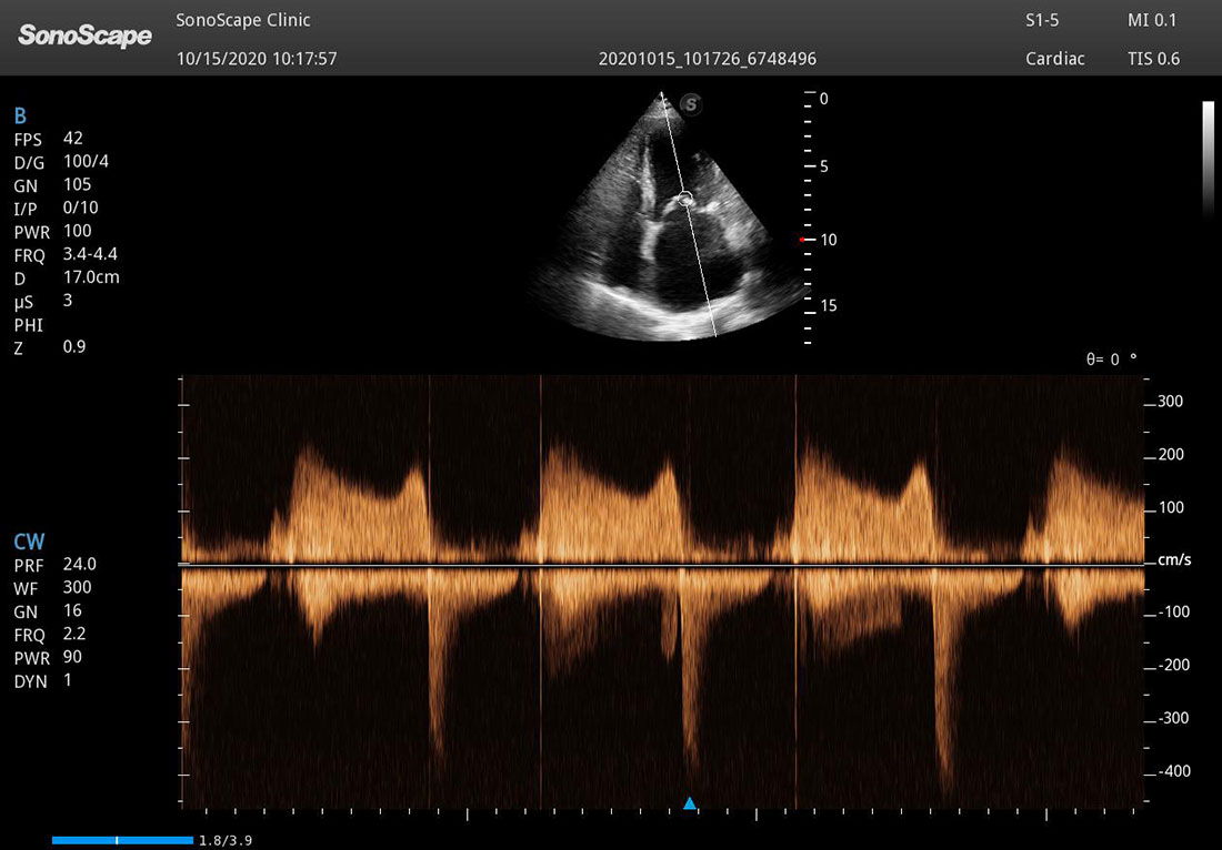 Sonoscape P50 Elite mobile color doppler ultrasound machine