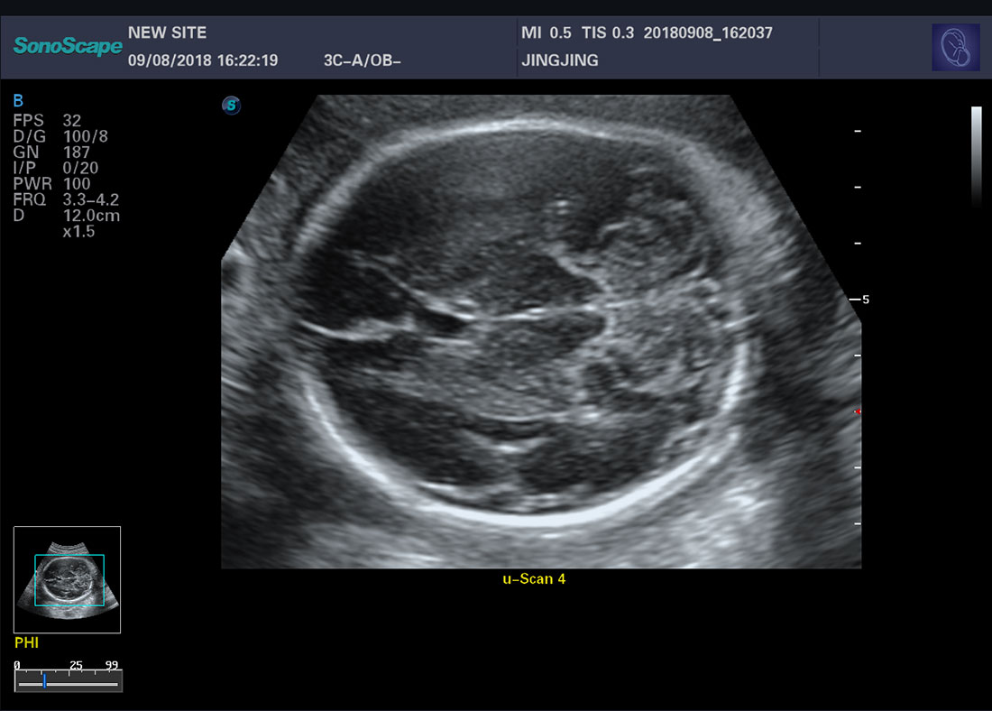 Color Doppler Trolley Ultrasound Scanner Sonoscape P20