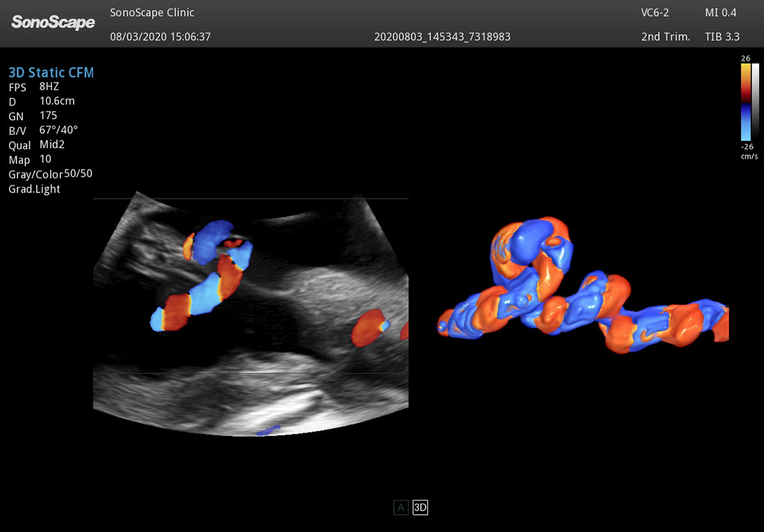 Sonoscape P50 Elite mobile color doppler ultrasound machine