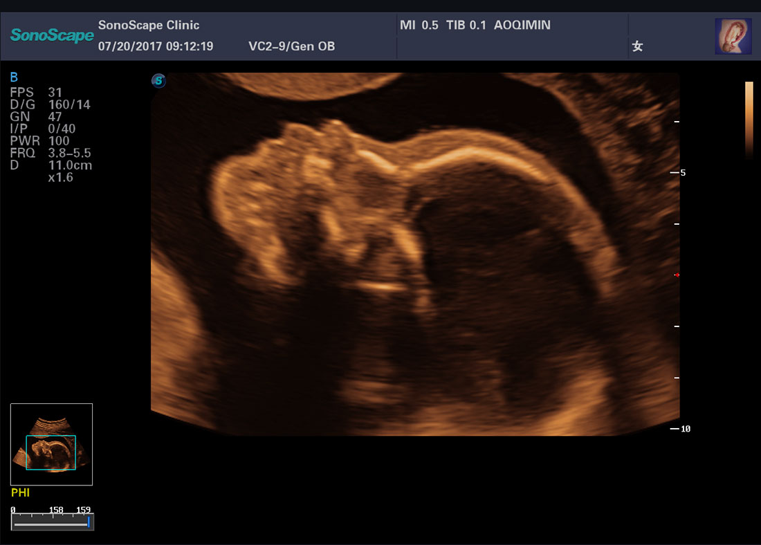 Sonoscape P50 4D Trolley Color Doppler Ultrasound Machine