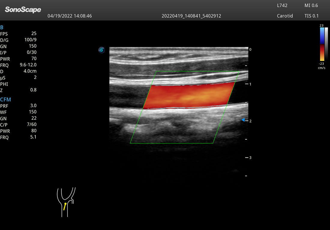 SonoScape P25 Elite Trolley 3D/4D Color Doppler Ultrasound Machine