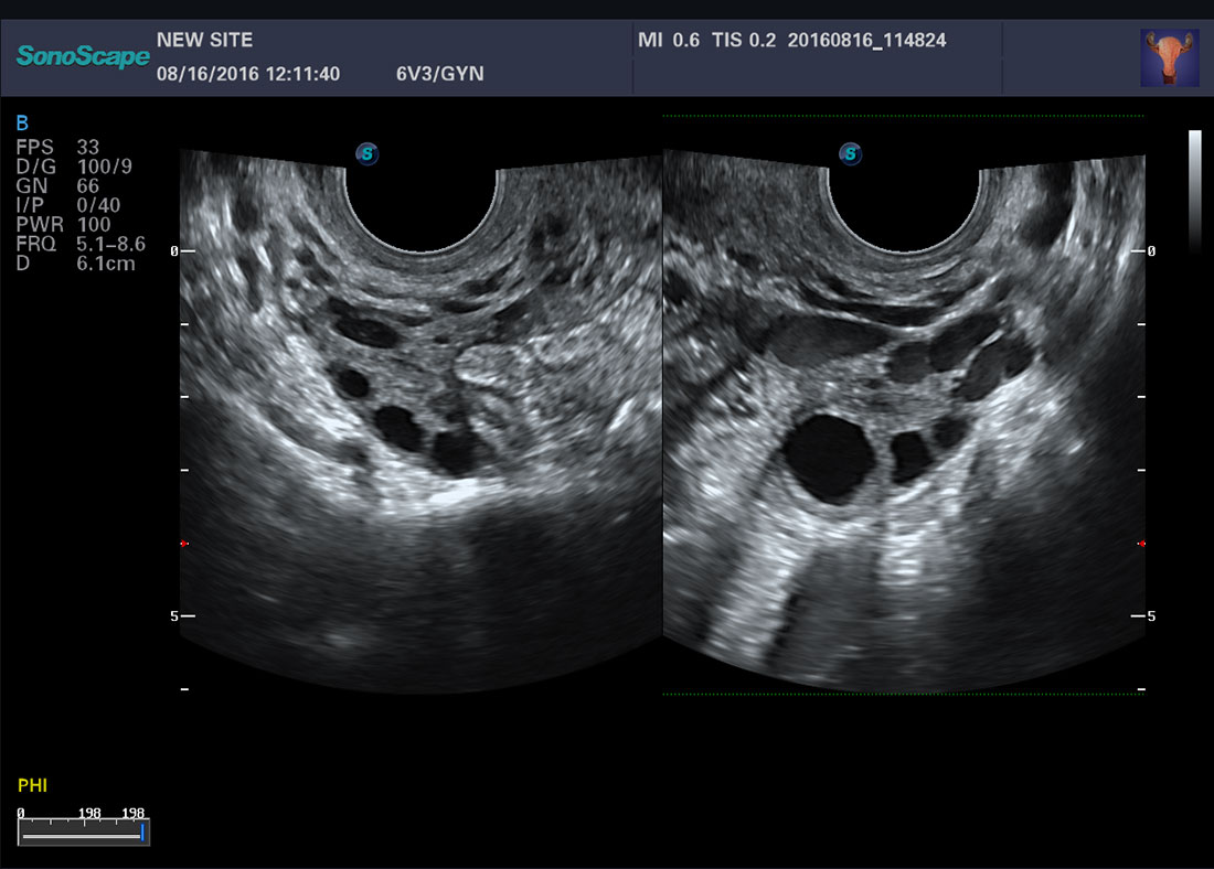 Sonoscape P50 4D Trolley Color Doppler Ultrasound Machine