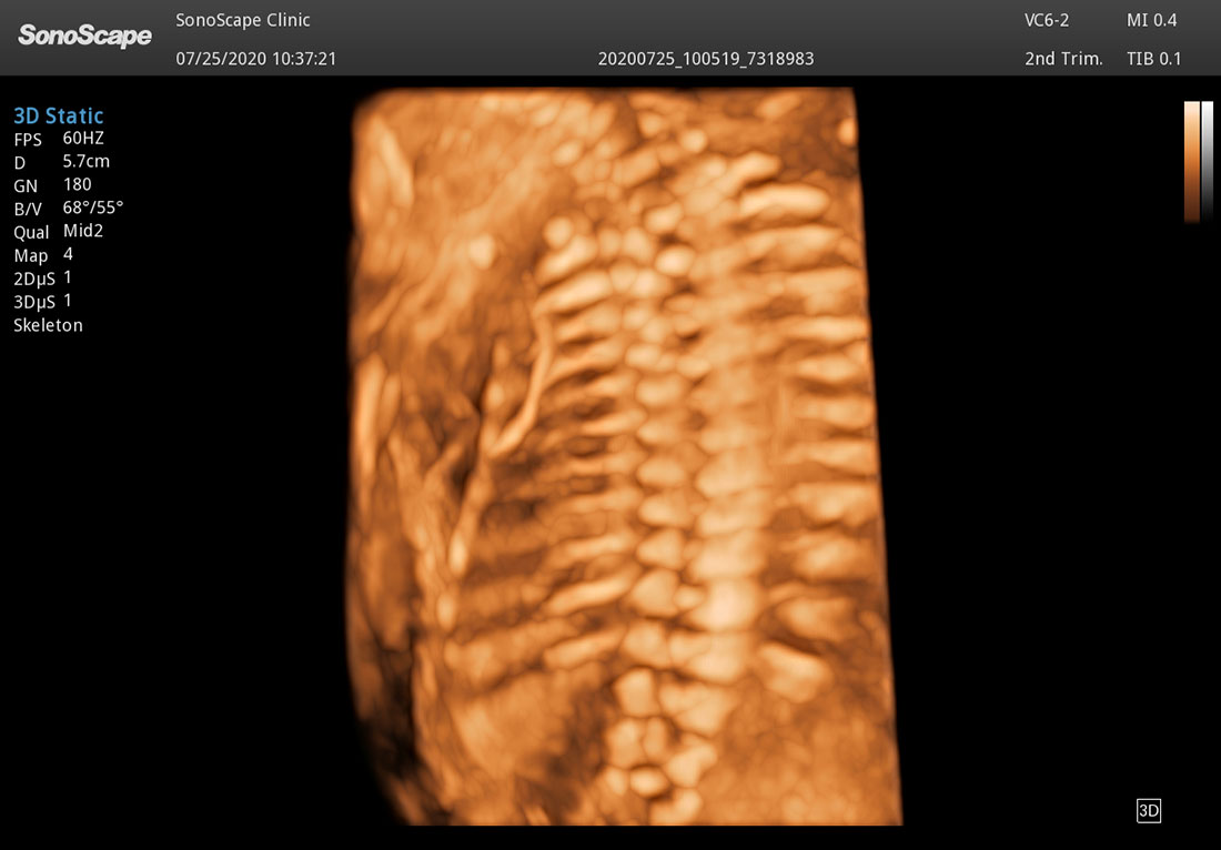 Sonoscape P50 Elite mobile color doppler ultrasound machine