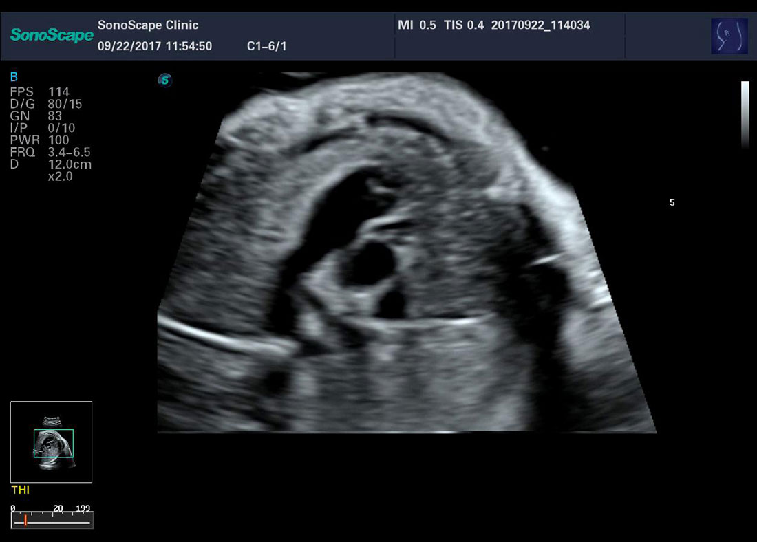 Sonoscape P50 4D Trolley Color Doppler Ultrasound Machine