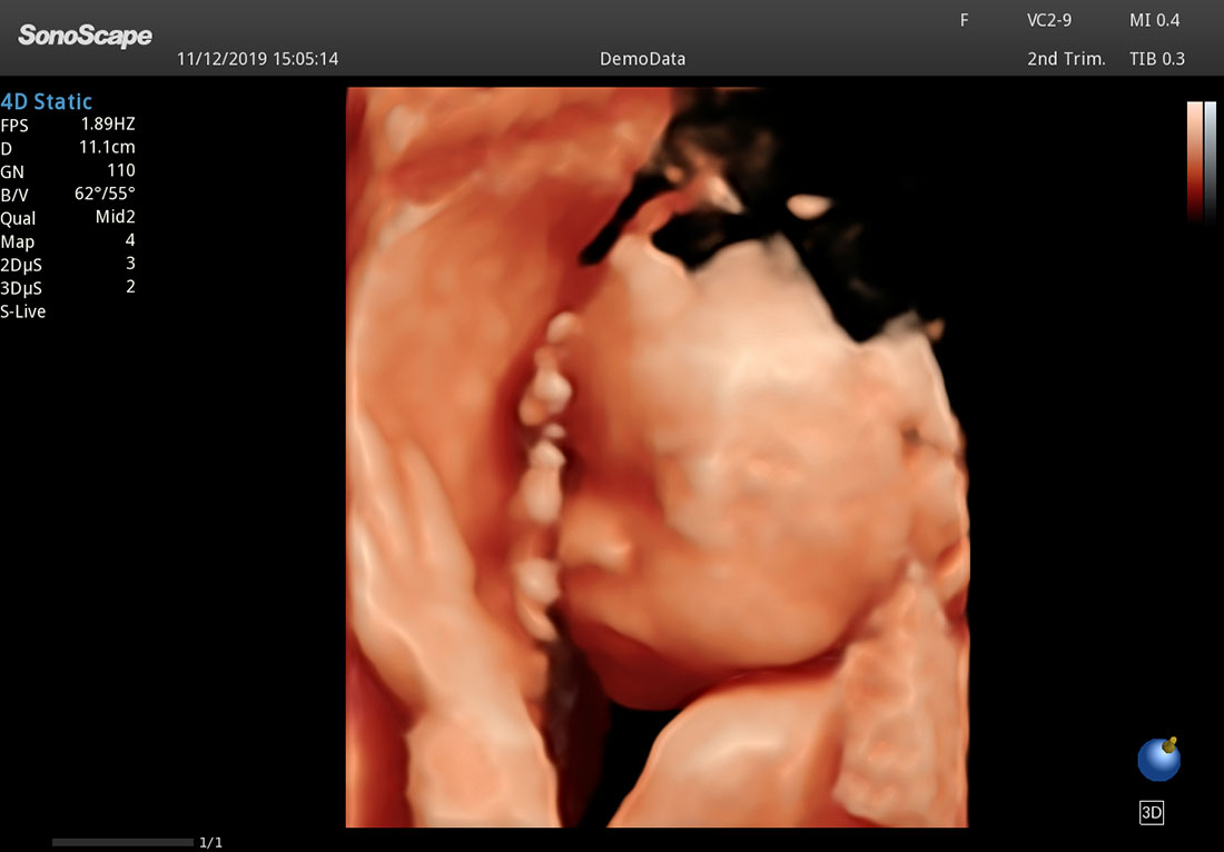 Sonoscape P60 mobile ultrasound doppler machines for sales