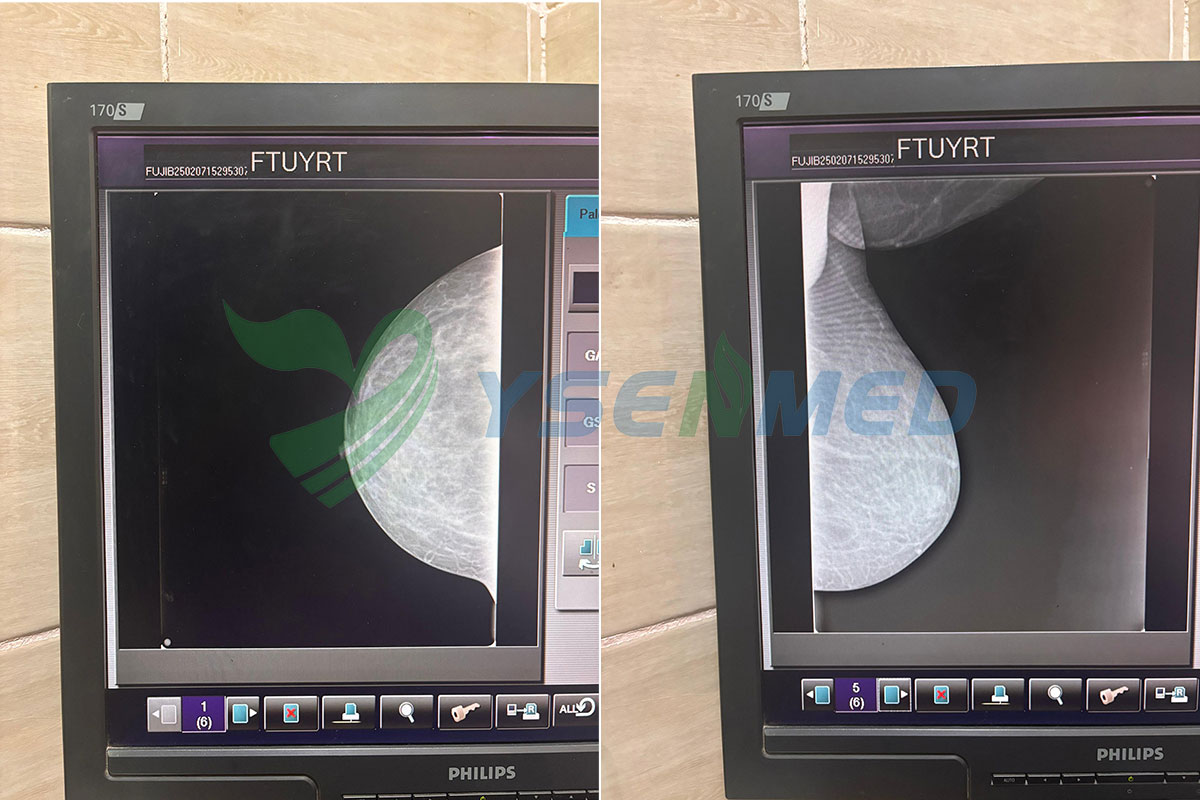 Le détecteur mammographique à panneau plat YSFPD-R1012C fonctionne bien dans un hôpital togolais.
