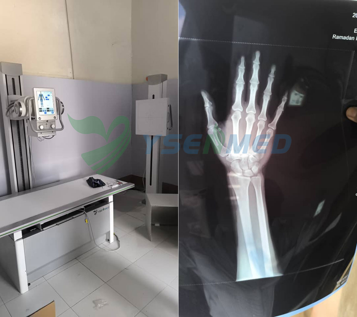 Système de radiographie numérique YSX500D installé dans un hôpital somalien.
