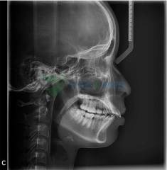 Sistema de radiografía panorámica digital dental YSENMED con cefalometría YSX1005C