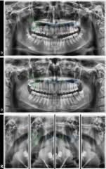 Sistema de radiografía panorámica digital dental YSENMED con cefalometría YSX1005C