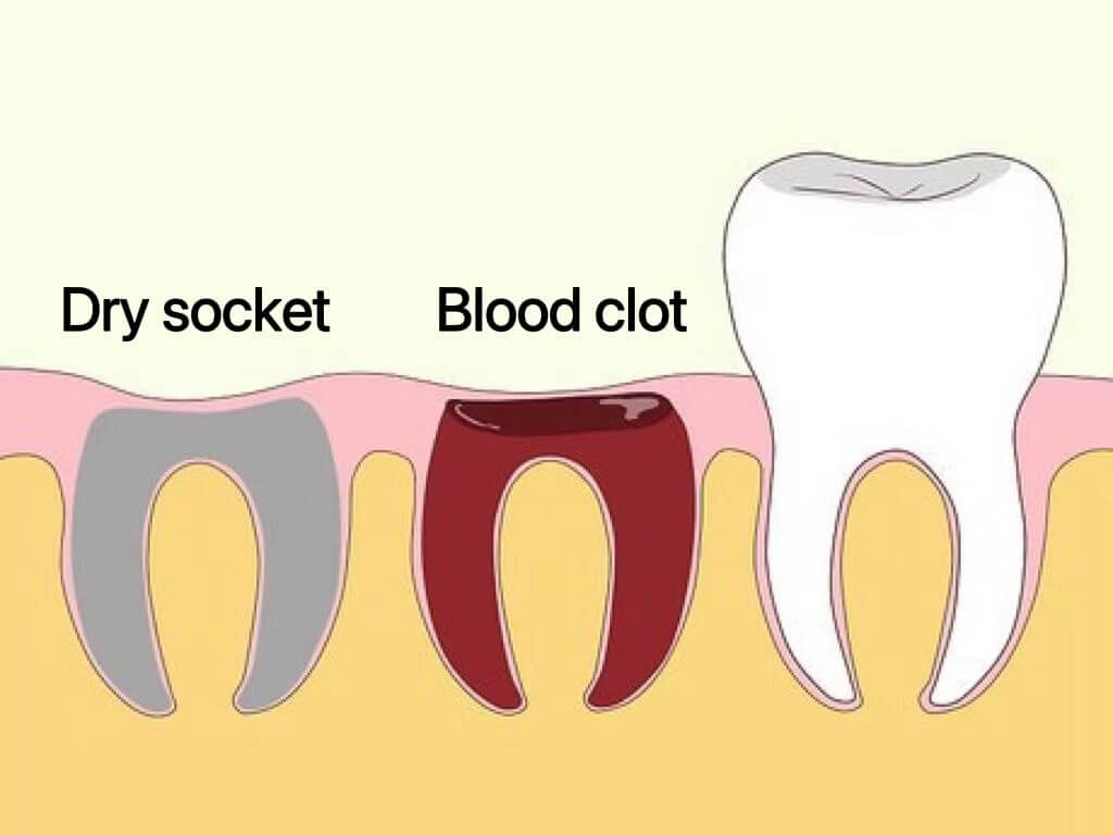 what is dry socket 