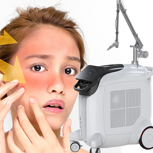 Q switched nd yag laser machine