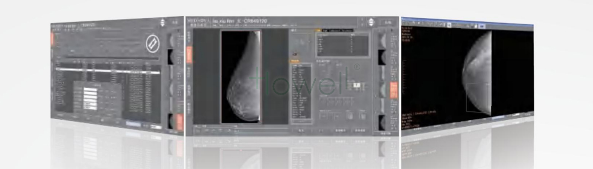 Digital Mammography System