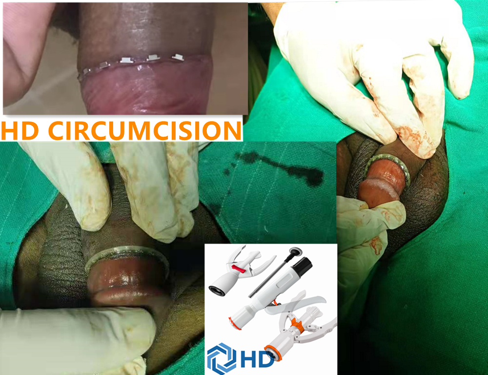 circuncisión con grapadora de circuncisión haida