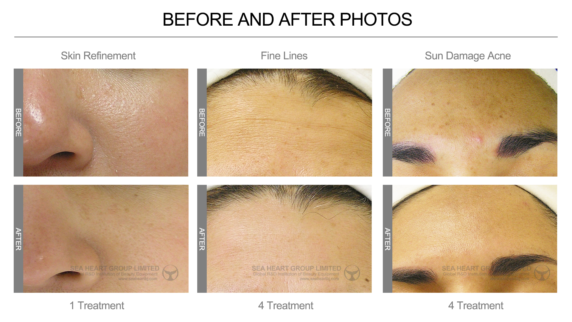 microdermabrasion before and after