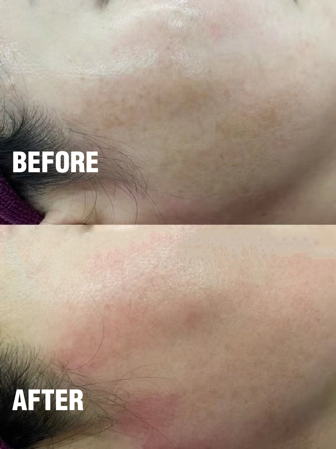 pico laser treatment before and after