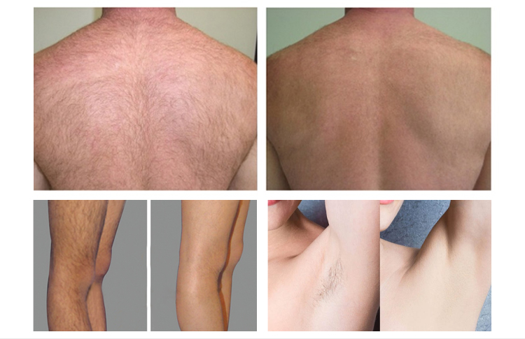 Before and after image of laser hair removal machine