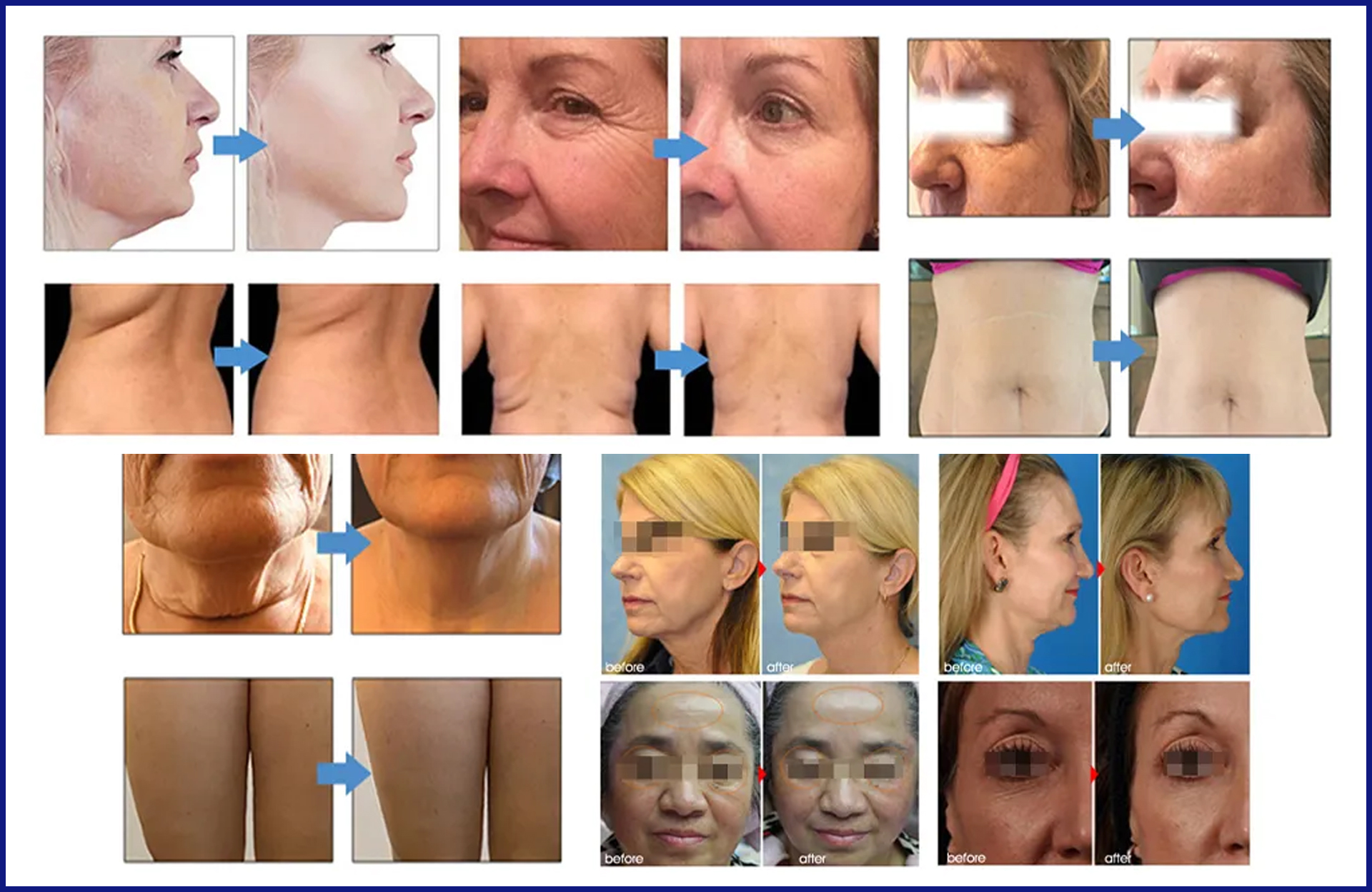 The Ultimate Guide to Professional Skin Tightening Machines: Boost Your Beauty Business
