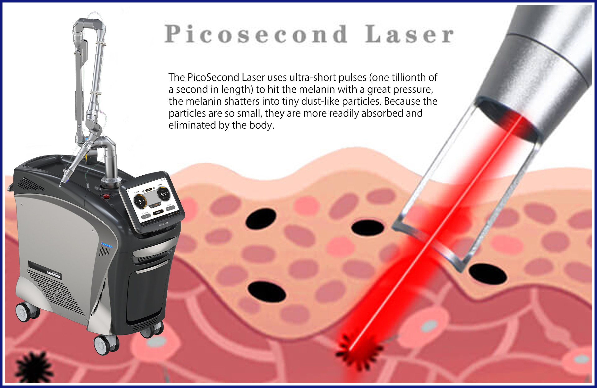 Understanding the Mechanism: How Does ND Yag Laser Work?