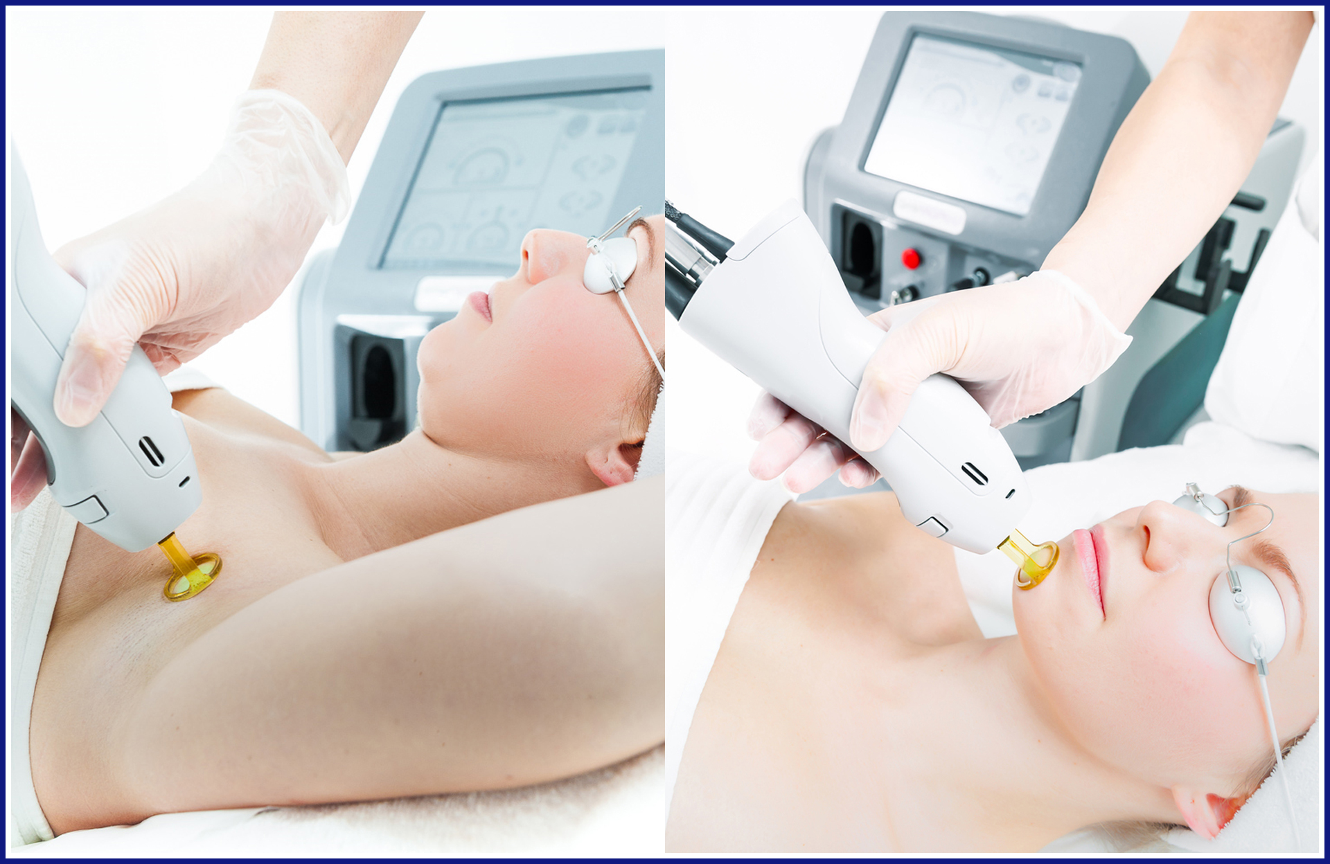 Unlocking Radiant Skin: The Power of Q-Switched Nd: YAG Laser