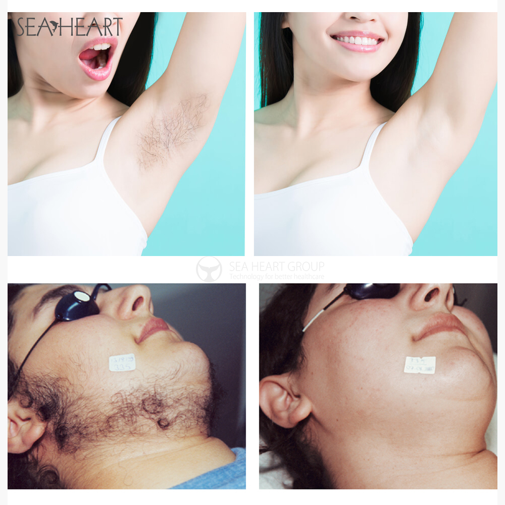 before and after for shr treatment