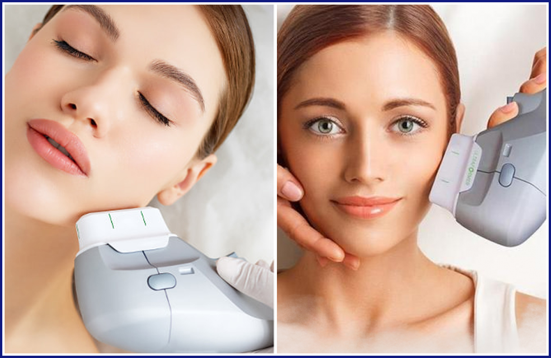 Ultherapy Vs Hifu: Unlocking the Secrets of Non-Surgical Skin Rejuvenation