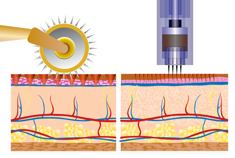 derma pen vs derma roller image