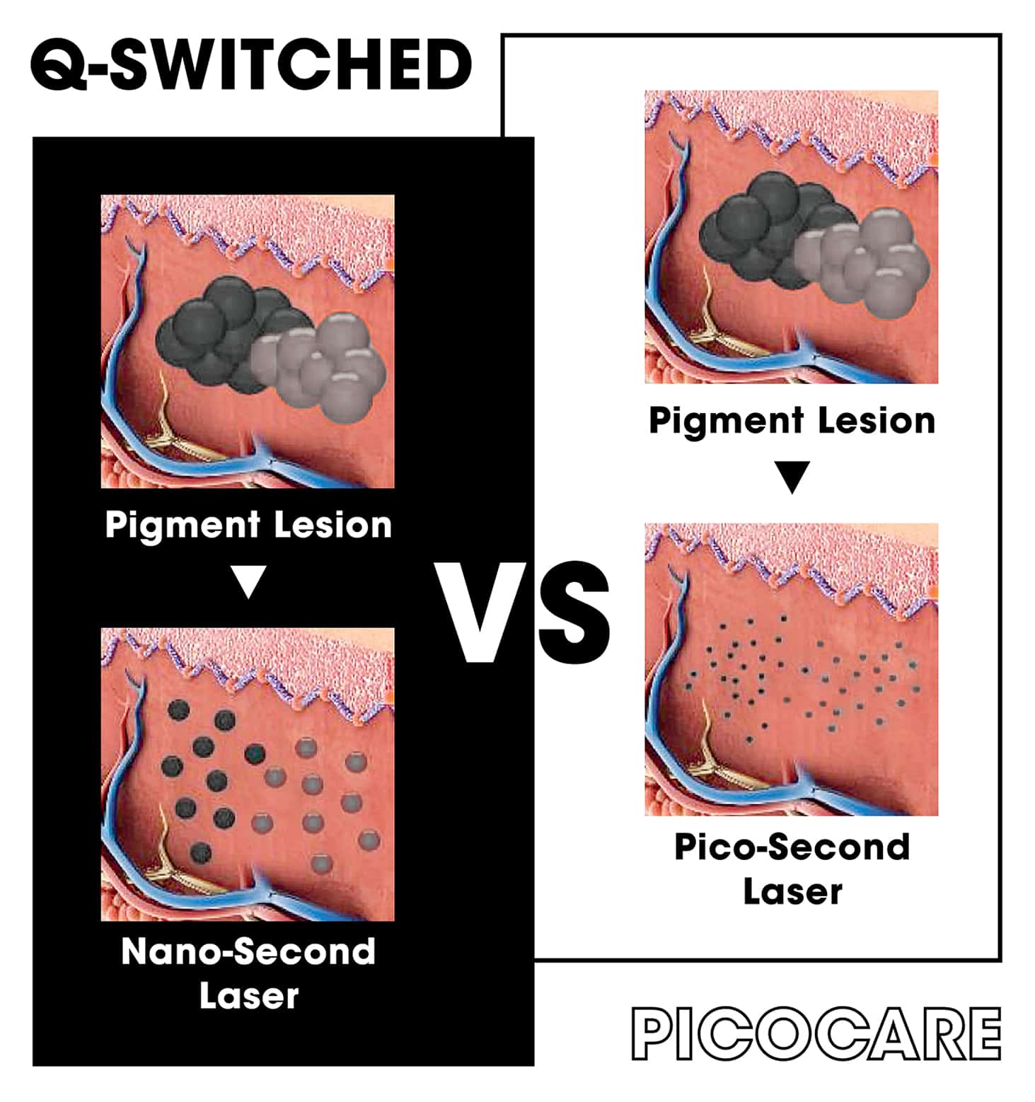 Pico Laser vs q switched laser SEA HEART GROUP