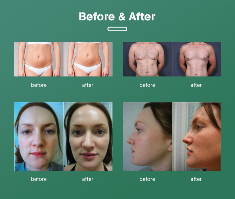 before and after image of fat cavitation treatment