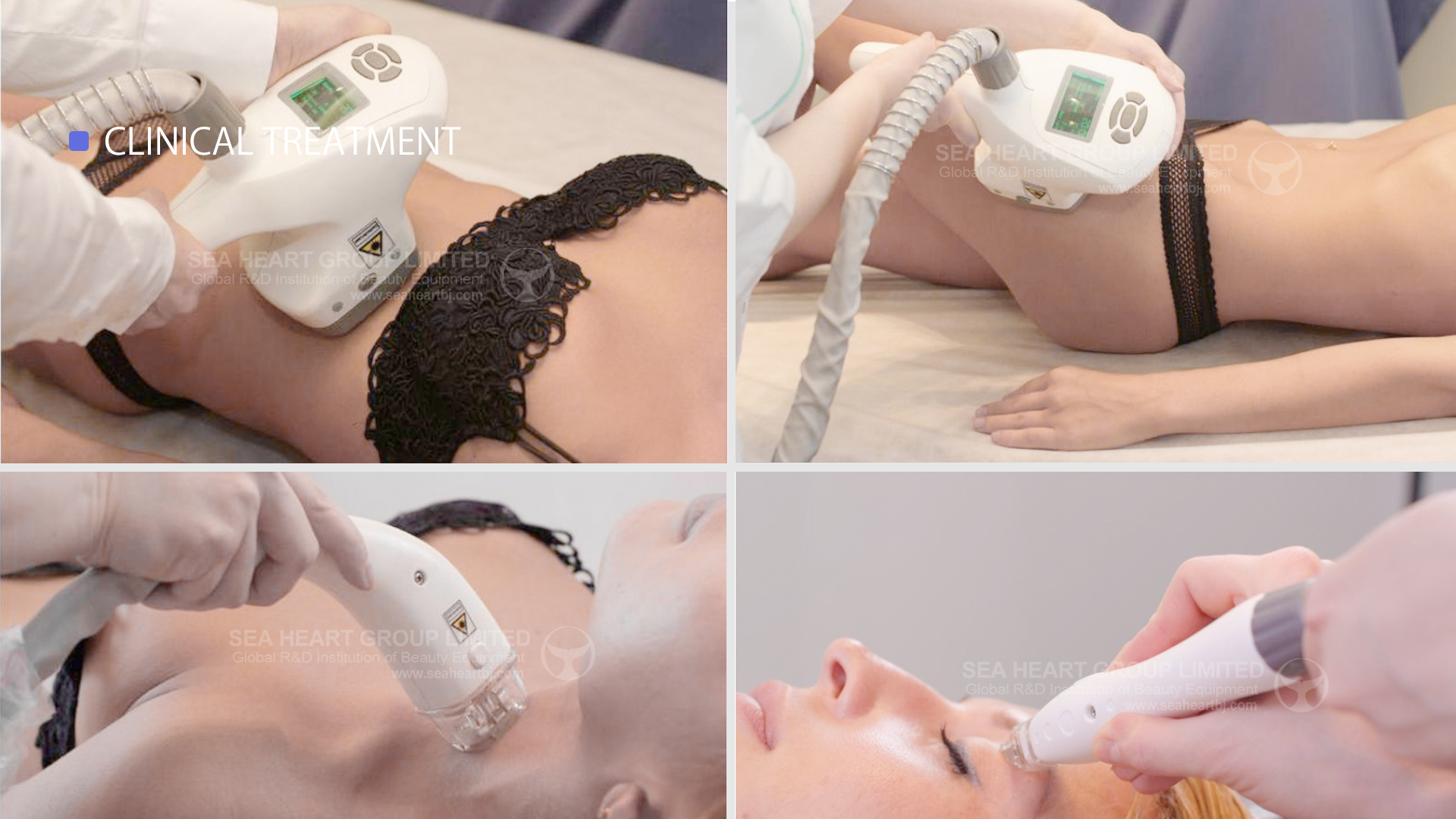 before and after image of velashape treatment