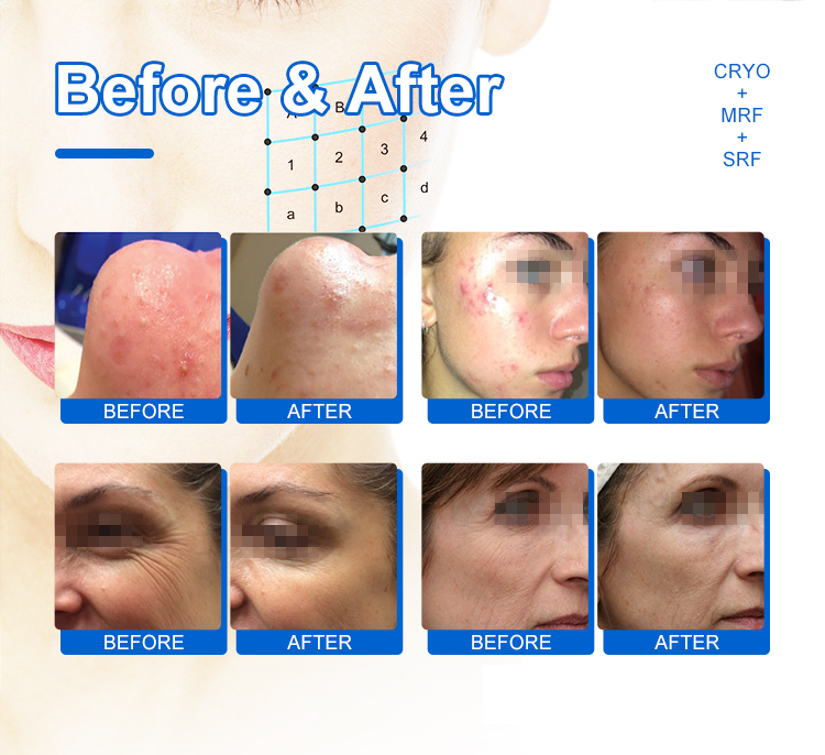 before and after images of rf microneedling treatment