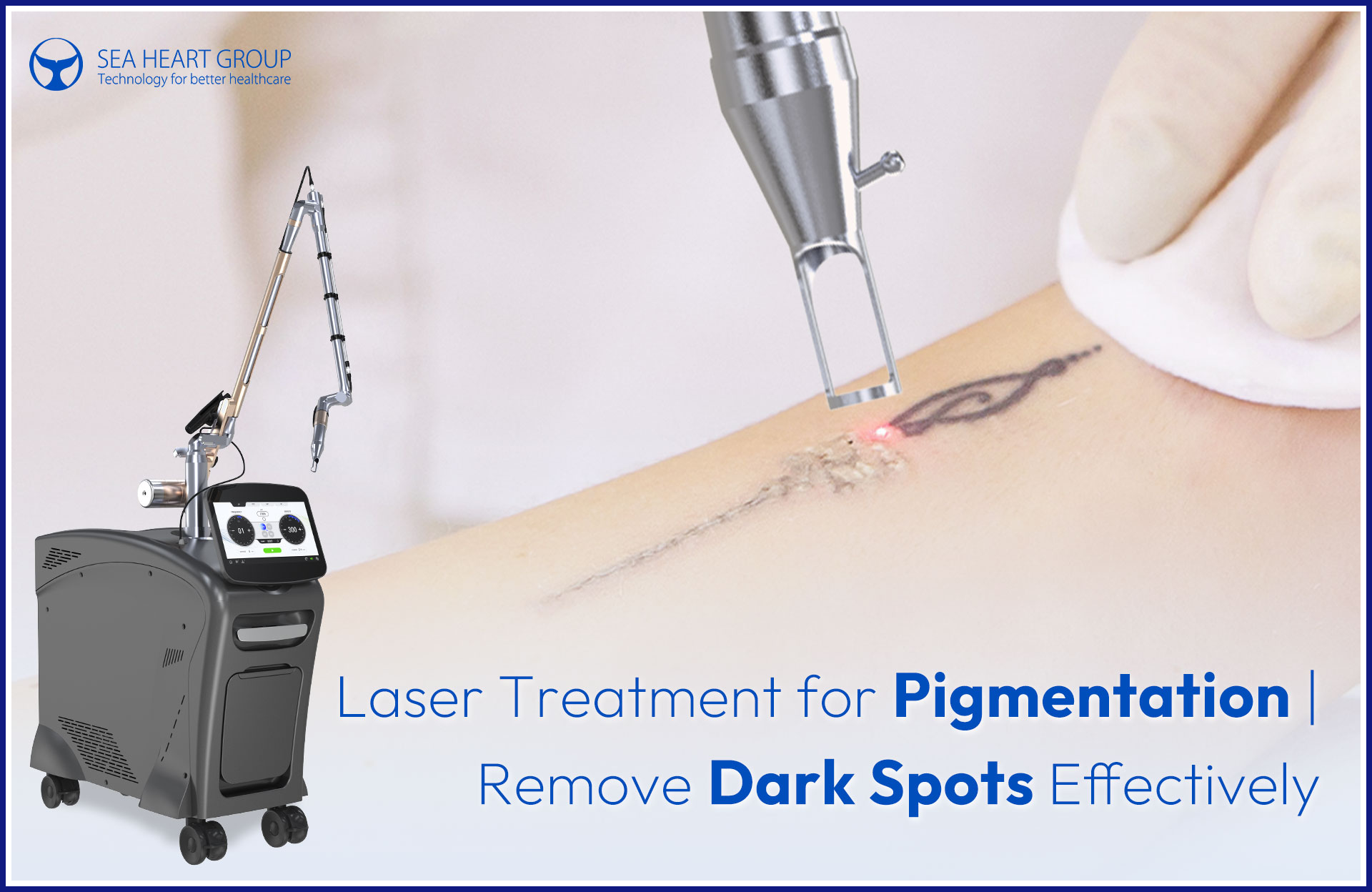 Laser Treatment for Pigmentation | Remove Dark Spots Effectively