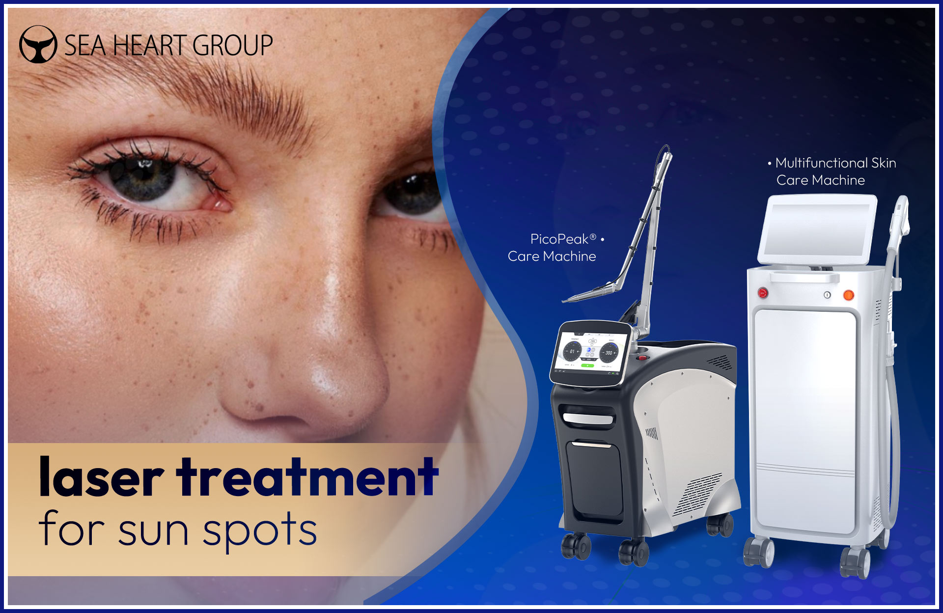Laser Treatment for Sun Spots: Picosecond Laser vs Q-Switched Nd:YAG Laser vs IPL – A Professional Guide
