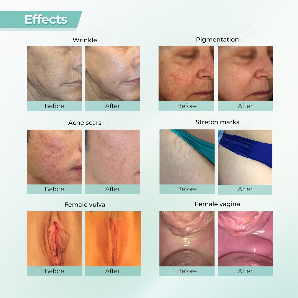 Acne Scar Treatment Before & After