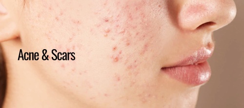 Acne&Scars