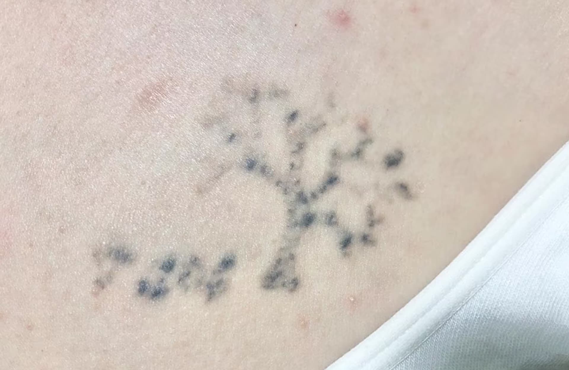 After tattoo removal